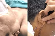 Cẩn thận u tuyến nước bọt tái phát gây liệt mặt, mù, chuyển ung thư