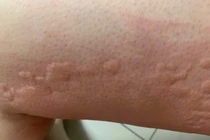 Mày đay cấp bùng phát mùa Tết, đừng chủ quan những mảng đỏ 'nở rộ' trên da