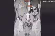 Không khám định kỳ, bất ngờ phải cắt thận vì ung thư vỡ