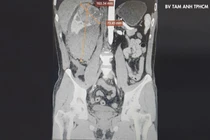 Không khám định kỳ, bất ngờ phải cắt thận vì ung thư vỡ