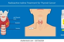 1% ung thư tuyến giáp nguy cơ thấp tử vong