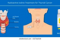 1% ung thư tuyến giáp nguy cơ thấp tử vong