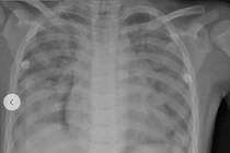 Đi bơi cùng cha, trẻ 10 tuổi ngạt nước nguy kịch