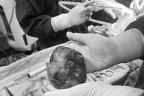 Phẫu thuật thành công u tuyến tiền liệt khổng lồ 600g cho cụ ông 83 tuổi