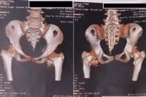 Cứng khớp sau cú ngã nhẹ, bé gái 12 tuổi phát hiện bệnh người hóa đá cực hiếm 