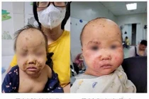 Bé gái 10 tháng tuổi bị viêm kết mạc do dị ứng thuốc nặng