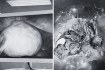 Loại bỏ u quái buồng trứng chứa đầy tóc, xương cho người phụ nữ mãn kinh