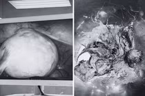 Loại bỏ u quái buồng trứng chứa đầy tóc, xương cho người phụ nữ mãn kinh