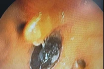 Nội soi gắp hạt hồng xiêm hơn 2cm nằm 4 tháng trong phế quản người bệnh