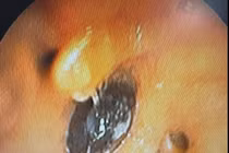 Nội soi gắp hạt hồng xiêm hơn 2cm nằm 4 tháng trong phế quản người bệnh