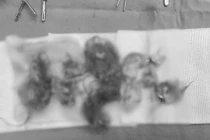 Tưởng đau bụng do rối loạn tiêu hóa không ngờ u quái buồng trứng