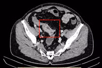 Cứu sống Việt kiều Mỹ bị bán tắc ruột do khối u đại tràng