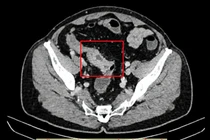 Cứu sống Việt kiều Mỹ bị bán tắc ruột do khối u đại tràng