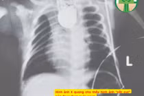 Teo thực quản bẩm sinh thường kèm dị tật tim, tiêu hóa