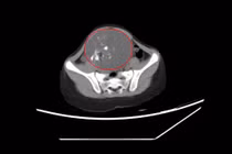 Bị táo bón bé gái 6 tuổi không ngờ mang u quái buồng trứng 