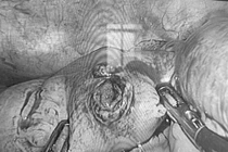 Cấp cứu thành công cho nam bệnh nhân bị đinh xuyên thủng ruột non