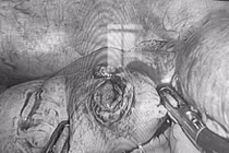 Cấp cứu thành công cho nam bệnh nhân bị đinh xuyên thủng ruột non