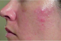 Chăm sóc đúng cách giúp kiểm soát viêm da tiết bã 