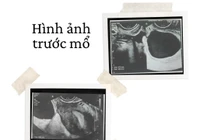 Cơn đau bụng bất thường không ngờ xoắn vòi tử cung hiếm gặp