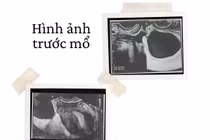 Cơn đau bụng bất thường không ngờ xoắn vòi tử cung hiếm gặp