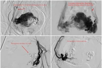 Nút mạch điều trị chảy máu tử cung do thông động tĩnh mạch hiếm gặp