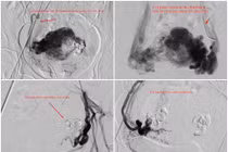 Nút mạch điều trị chảy máu tử cung do thông động tĩnh mạch hiếm gặp