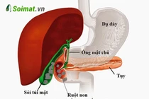 Cụ bà 77 tuổi nguy kịch vì sỏi túi mật gây tắc ruột non