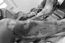 Người phụ nữ bỏng nặng tay, chân khi nướng cá bằng cồn