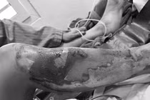 Người phụ nữ bỏng nặng tay, chân khi nướng cá bằng cồn