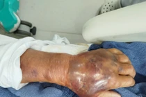Chủ quan vết tôn cứa nhẹ người đàn ông nguy kịch vì vi khuẩn “ăn thịt người”