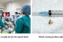 Cảnh báo tình trạng hóc dị vật khi ăn uống, cần biết cách phòng tránh