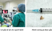 Cảnh báo tình trạng hóc dị vật khi ăn uống, cần biết cách phòng tránh
