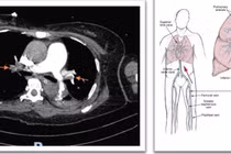Giành lại sự sống cho người bệnh ngừng tim sau mổ u