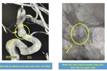 Thỉnh thoảng đau đầu không ngờ dị dạng túi phình sắp vỡ