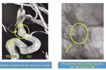 Thỉnh thoảng đau đầu không ngờ dị dạng túi phình sắp vỡ