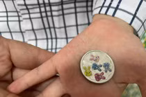 Đồng xu 2,5 cm mắc kẹt trong thực quản bé gái hơn 5 tuổi