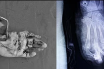 Nguy cơ mất toàn bộ bàn tay trái vì pháo nổ