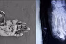 Nguy cơ mất toàn bộ bàn tay trái vì pháo nổ