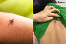 Sốt cao, rét run, người đàn ông 46 tuổi nguy kịch từ vết mò đốt