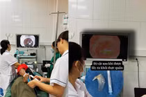 Xương cá 2,5 cm mắc tại thực quản, nguy hiểm của hóc xương