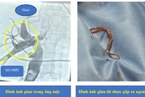 Tán sỏi đường mật, phát hiện giun trong ống mật