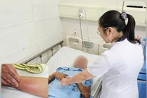 Người đàn ông Phú Thọ áp xe, nhiễm trùng huyết vì 'cấy chỉ' chữa đau lưng