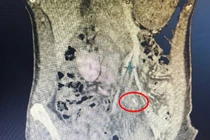 Phát hiện xương cá 5 cm đâm thủng ruột non sau 5 ngày đau bụng