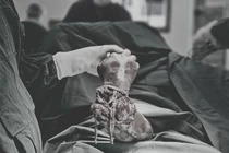 Vi phẫu nối lại cẳng tay đứt lìa cho nam bệnh nhân