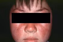 Trẻ 13 tuổi suy hô hấp, tổn thương phủ tạng do lupus ban đỏ