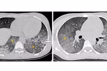 Nghẹt thở hành trình cứu trẻ 14 tuổi biến chứng lupus ban đỏ