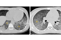 Nghẹt thở hành trình cứu trẻ 14 tuổi biến chứng lupus ban đỏ