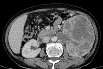 Tiểu máu, bụng chướng nhẹ phát hiện u thận khổng lồ xâm lấn đài bể thận