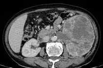 Tiểu máu, bụng chướng nhẹ phát hiện u thận khổng lồ xâm lấn đài bể thận