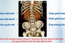 Ca tán sỏi phức tạp cho người đàn ông có dị tật thận đôi cực hiếm gặp